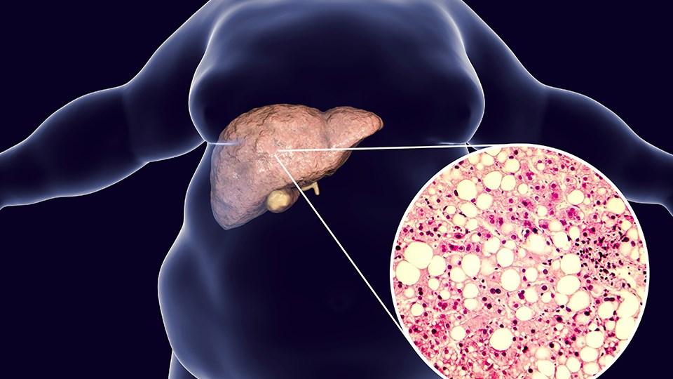 Μη αλκοολική λιπώδης ηπατική νόσος (NAFLD) - ΤΙ ΕΙΝΑΙ; ΚΙΝΔΥΝΟΙ